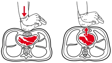 Cutaway diagram showing chest under CPR compressions